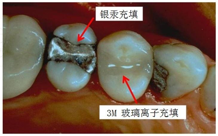 3m 玻璃离子