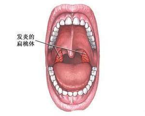 化脓性扁桃体炎