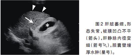 肝硬化的超声诊断技术