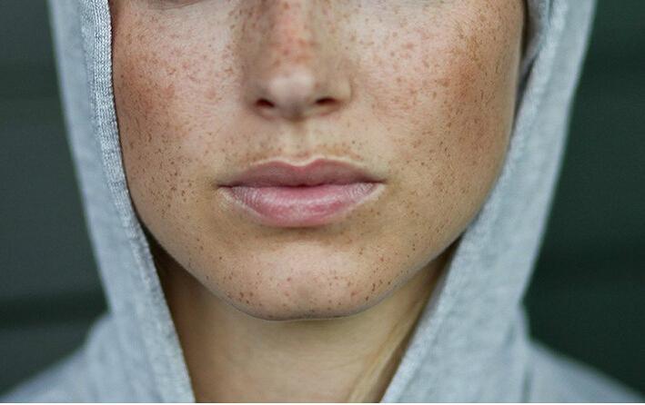 色斑是由于皮肤黑色素的增加而形成的一种常见面部呈褐色或黑色素沉着