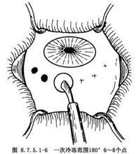 睫状体冷冻术