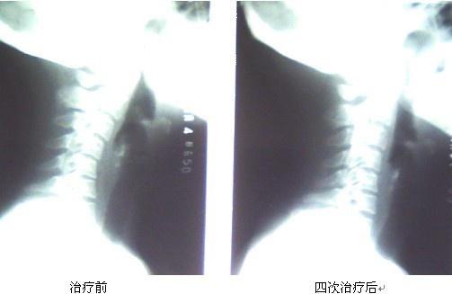 颈椎轻度反弓严重是什么症状 腰椎反弓怎么治疗 颈椎可以贴暖宝宝吗