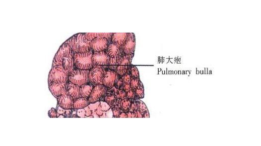 肺大泡