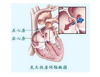 仅次于室间隔缺损,系胚胎发育期心房间隔上残留未闭的缺损而形成