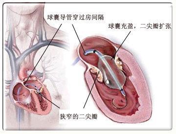 二尖瓣狭窄