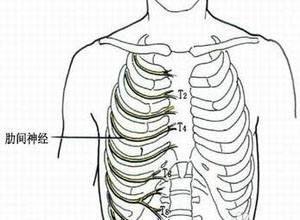 肋间神经痛
