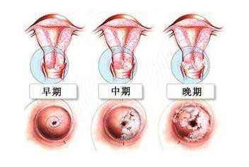 hpv(人乳头状瘤病毒) 表现为寻常疣,生殖器疣(尖锐湿疣)等症状.