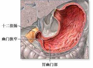 幽门肿块