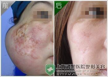 皮肤软组织扩张术