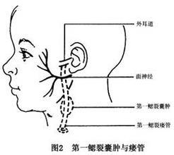 颈咽先天性疾病鳃裂囊肿及瘘管