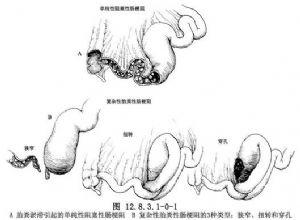 回肠切除术及双腔回肠造口术