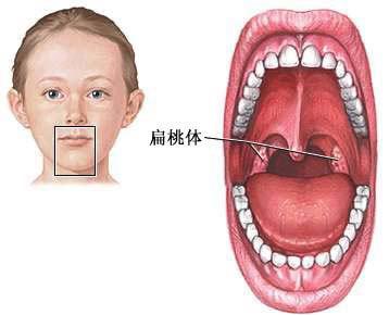 儿童扁桃体炎