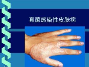 真菌性皮肤病