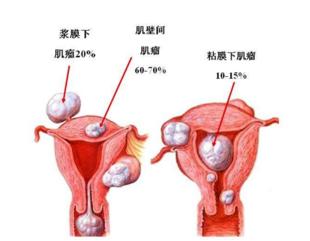 宫颈肌瘤