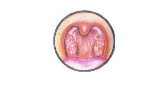 舌根部淋巴滤泡增生