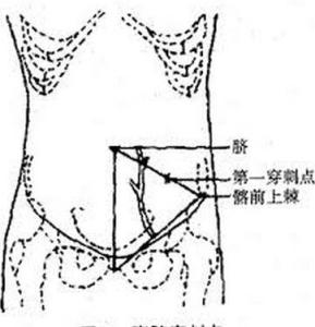 腹腔穿刺术