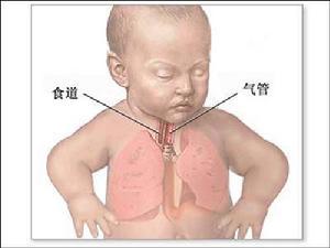 宝宝吸入性肺炎症状 肺炎 如果吸入二氧化硫引起肺炎,可以排除肺里的