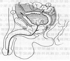 腹式输卵管结扎致切口膀胱瘘1例