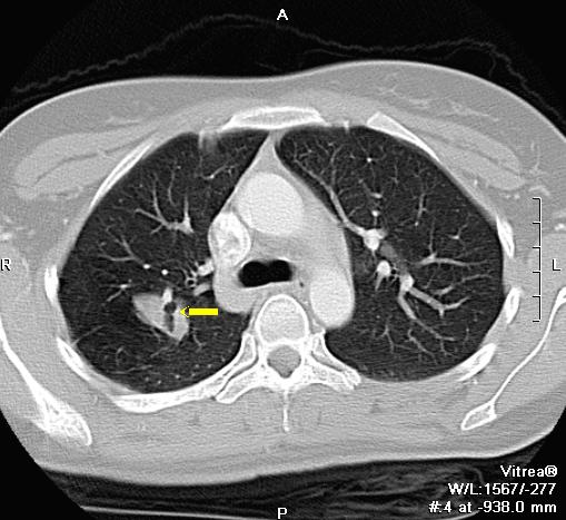 支气管肺囊肿图片