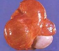睾丸或附睾部发生囊肿,囊肿液内含精子