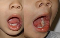 混合型脉管畸形