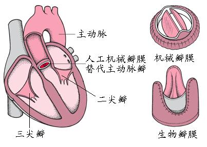 【联合瓣膜病变诊断依据