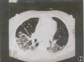 什么是特发性肺纤维化 bki-20090715184534-1594631690.jpg