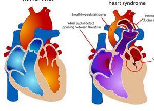 左心發育不良