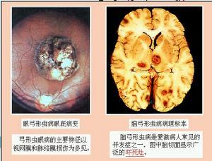 先天性弓形体病