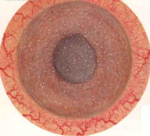 慢性闭角型青光眼