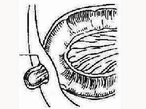 小儿疝气即小儿腹股沟疝气,俗称「脱肠」,是小儿普通外科手术