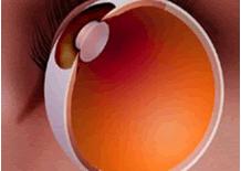 白内障の兆候と症状