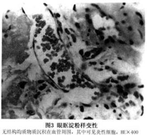 眼部淀粉样变性