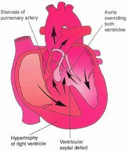 又稱發紺四聯症,是聯合的先天性心臟血管畸形,本病包括室間隔缺損,肺