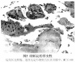 眼部淀粉样变性