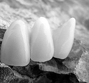 镍镉烤瓷牙即镍铬合金烤瓷牙.