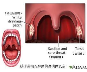 急性咽喉炎