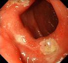 急性糜烂性食管炎