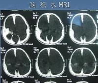 正常颅压脑积水