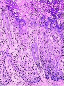 鲍温病(bowens disease,是一种较少见的早期皮肤原位鳞癌,大多在45岁