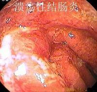 溃疡性结肠炎患者慎用