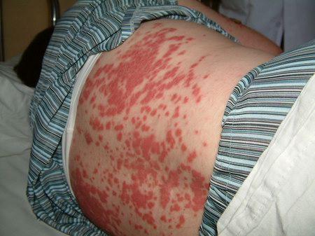 荨麻疹变成大片红斑图片