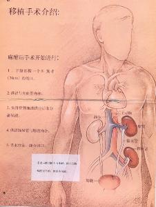 什么是自主移植肾 bki-20120529143620-1571602035.jpg