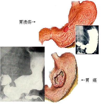 胃癌症状图片早期图片