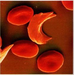 镰刀形红细胞贫血症