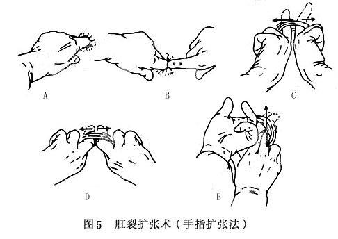 女性肛裂 搜狗百科