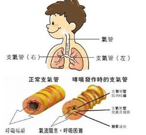 过敏性哮喘原理