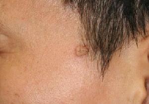 中医治疗扁平疣找重庆扁平疣医院?