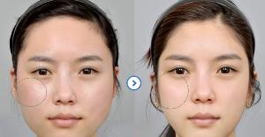  求美网颧骨整形效果图