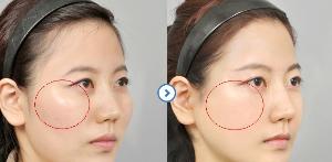  求美网颧骨先整形前后对比